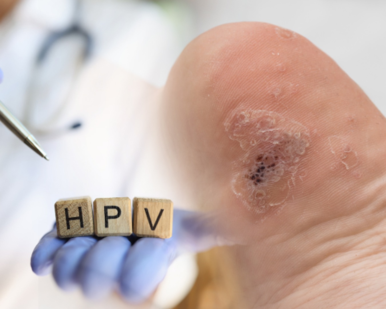 Human Papillomavirus (HPV)