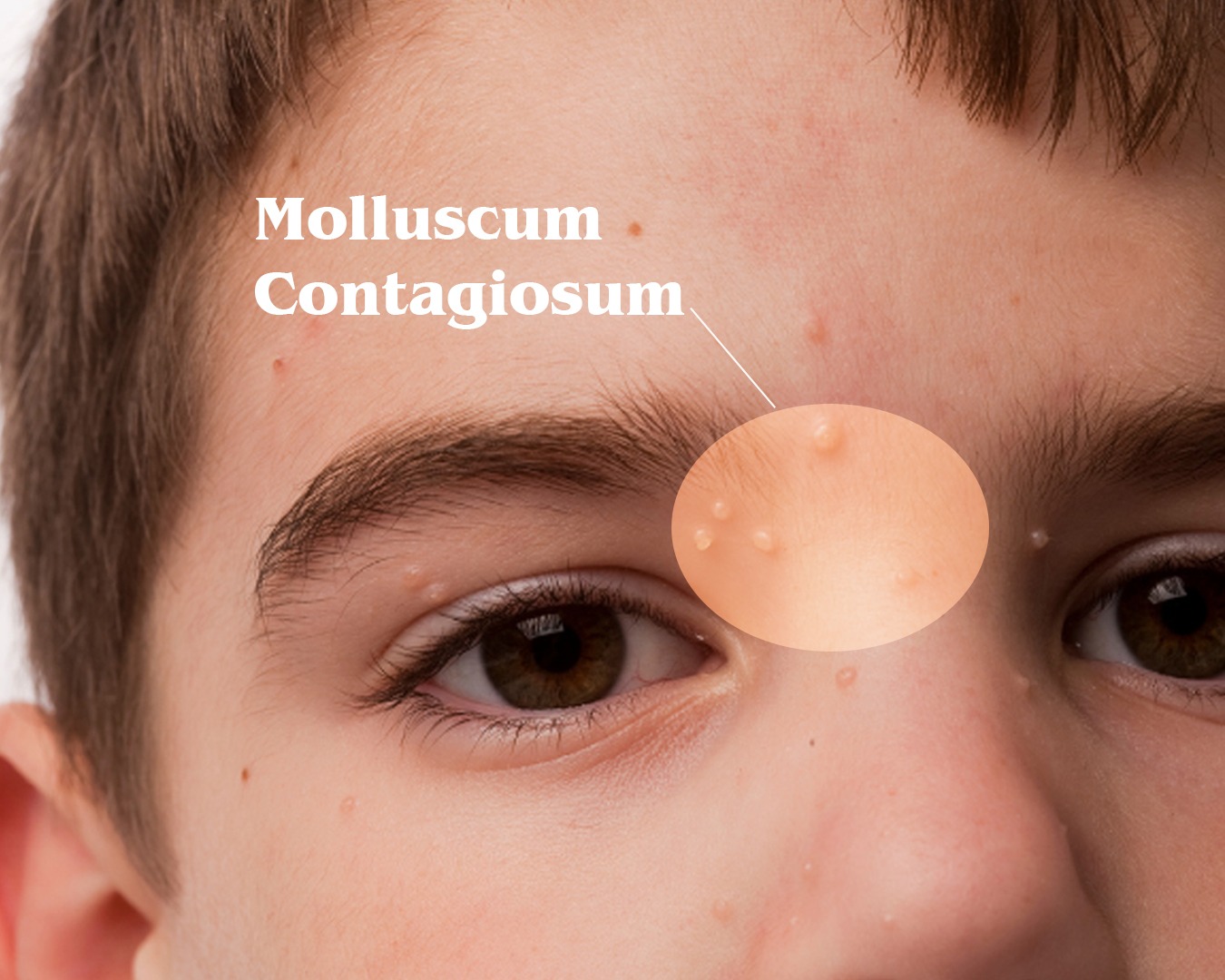 molascum contagioscum